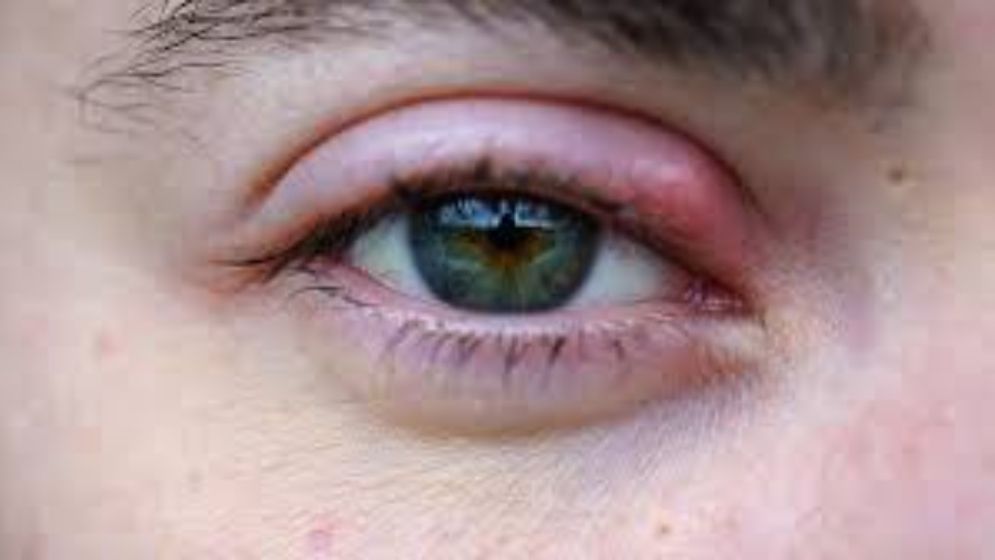 চোখে অঞ্জনি হলে কী করবেন