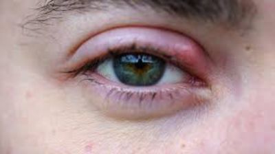 চোখে অঞ্জনি হলে কী করবেন