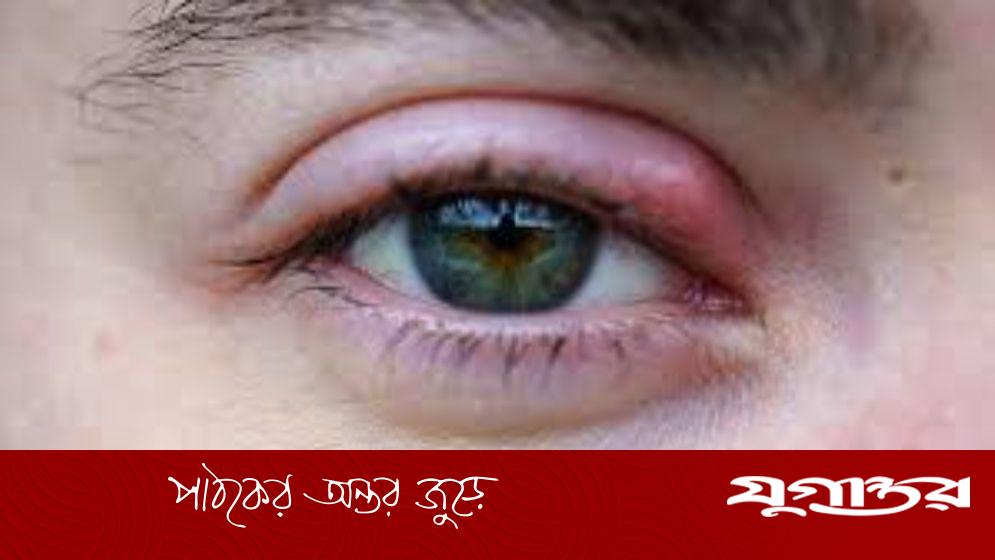 চোখে অঞ্জনি হলে কী করবেন
