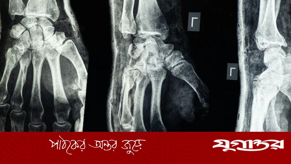 ৩ মিনিটেই জোড়া লাগবে ভাঙা হাড়, চীনে বিজ্ঞানীদের নতুন আবিষ্কার