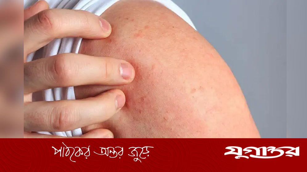 অ্যালার্জি রুখতে যে খাবার খাবেন