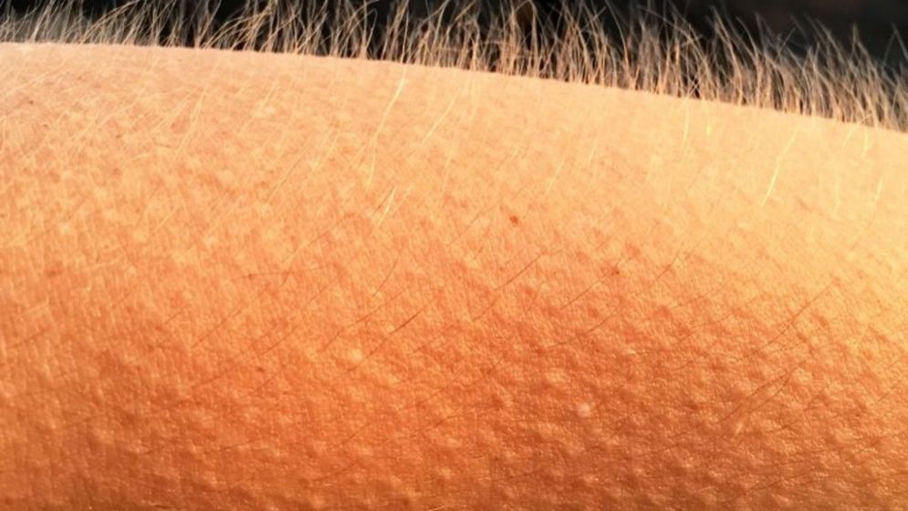 শরীরে অতিরিক্ত লোম