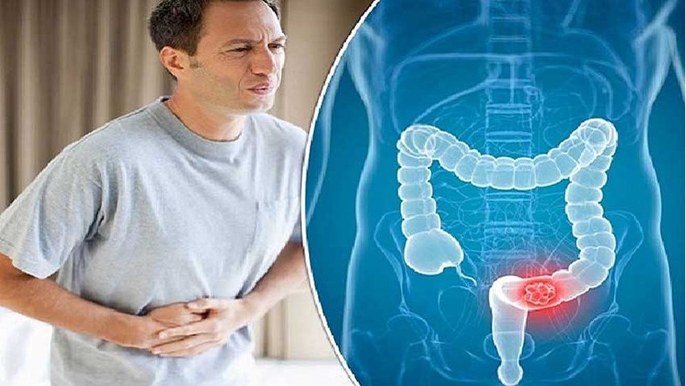 কোষ্ঠকাঠিন্য দূর করার সহজ কয়েকটি ঘরোয়া উপায়