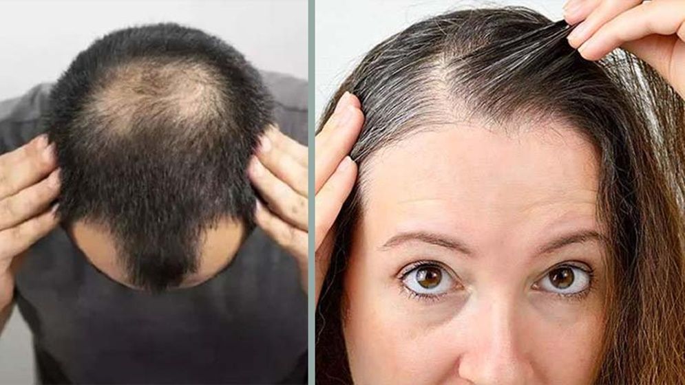 মাথার চুল পড়া রোধ করতে পারে এই ১০ উপাদান