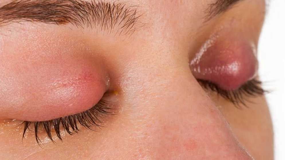 চোখ ওঠা এখন আর অবহেলার রোগ নয়