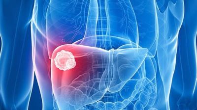 লিভার ক্যানসার প্রতিরোধ করতে চান? ৬ বিষয় মেনে চলুন