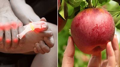 নিয়ন্ত্রণের বাইরে ইউরিক অ্যাসিড, প্রতিদিন খান ৩ ফল