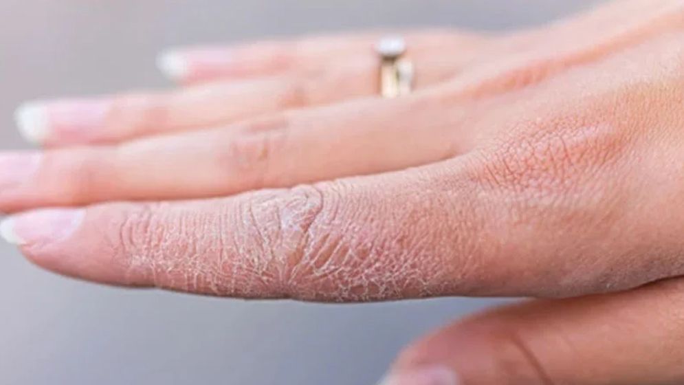 শীতকালে ত্বক শুষ্ক কেন হয়? জানুন এর প্রতিরোধ