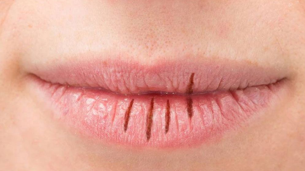 ঠোঁট শুকিয়ে ফেটে যাচ্ছে, ঘরোয়া উপায়ে সমাধান