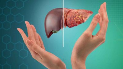 ফ্যাটি লিভারের ৮টি লক্ষণ, যা দেখা মাত্র উপেক্ষা করা যাবে না