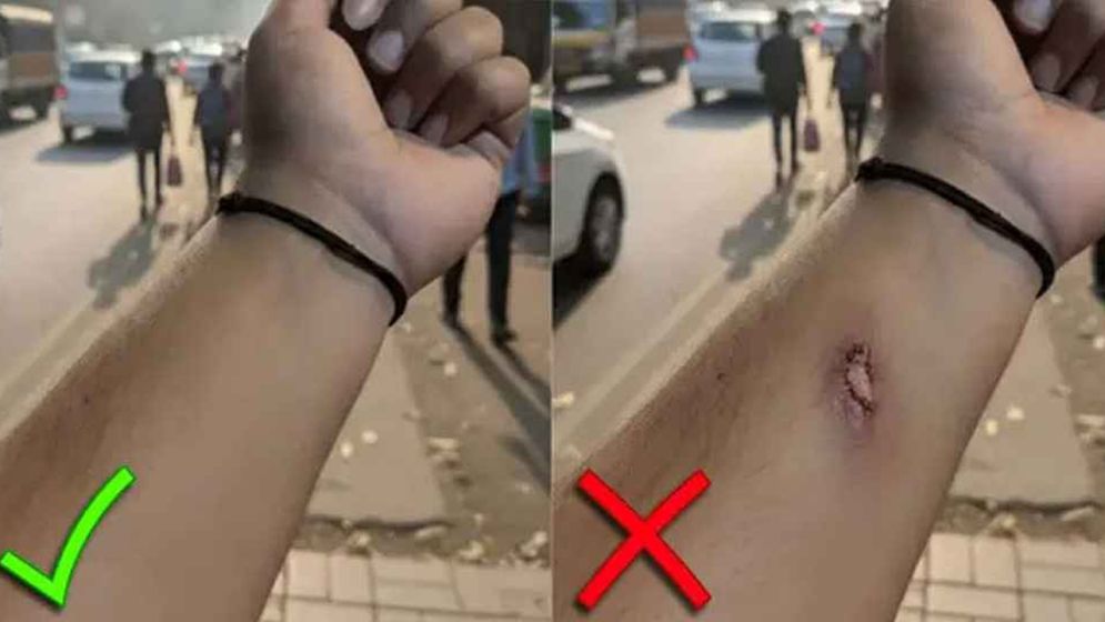 এআই দিয়ে আহত হাতের ছবি বানিয়ে ছুটি নিলেন অফিস কর্মী