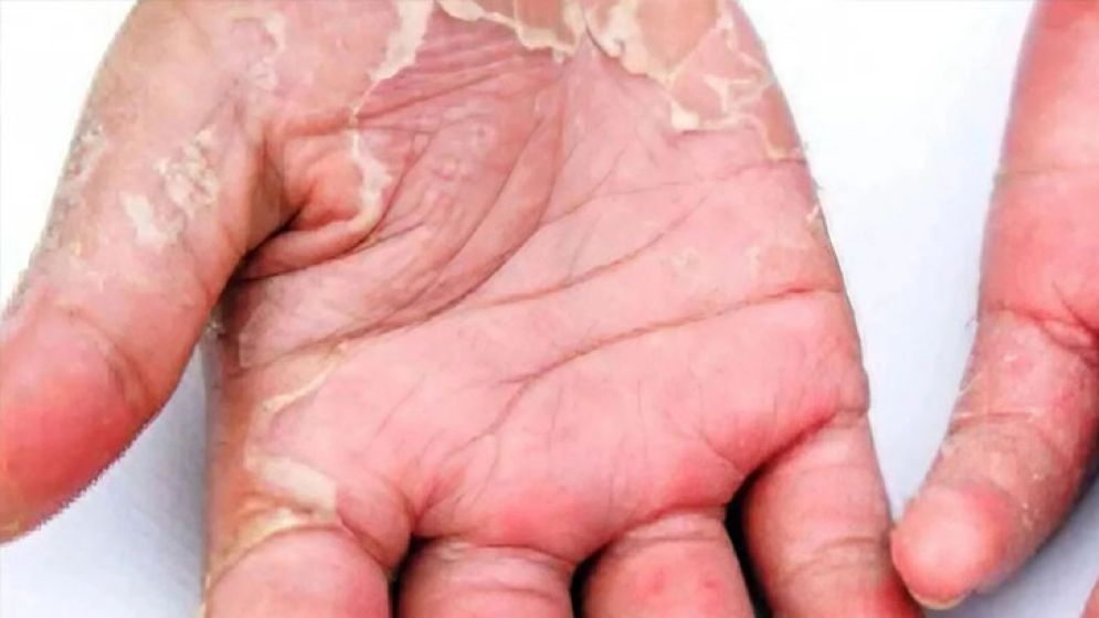 শীতে হাতের চামড়া উঠে যাচ্ছে? রক্ষা পাবেন যেভাবে