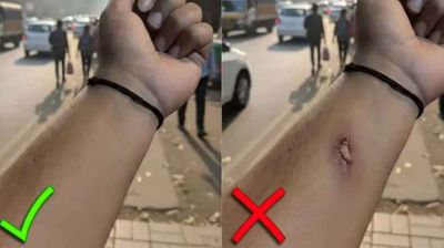 এআই দিয়ে আহত হাতের ছবি বানিয়ে ছুটি নিলেন অফিস কর্মী