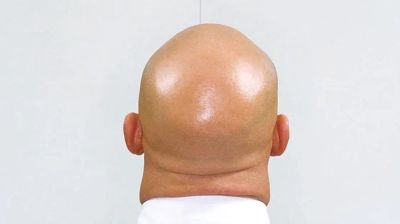 মাথায় টাক পড়ার কারণ হার্টের অসুখ নয় তো?