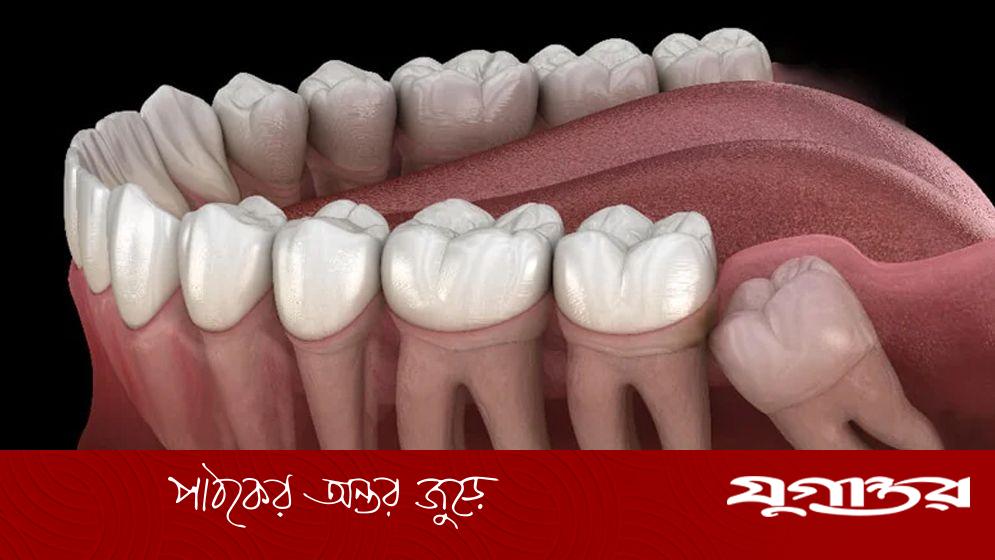 আক্কেল দাঁত যখন তোলা উচিত