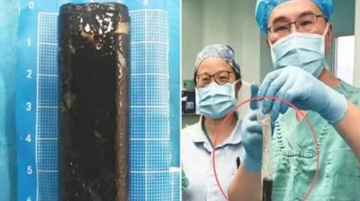 ৩০ বছর পর রোগীর পেট থেকে বের করা হলো লাইটার