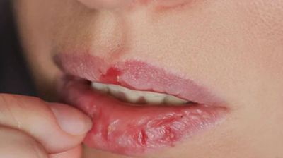 শীতে ঠোঁট ফাটার কারণ ও প্রতিকার