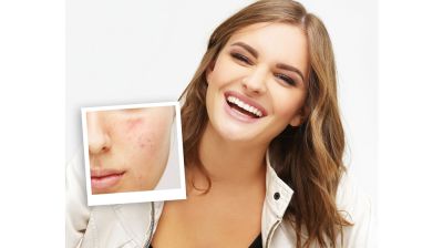 মুখভর্তি ব্রণের দাগ, যেভাবে মুক্তি পাবেন