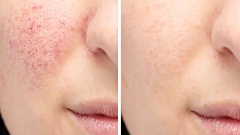 মুখের গর্ত নিয়ে চিন্তিত, জেনে নিন মসৃণ ত্বক ফিরে পাওয়ার উপায়