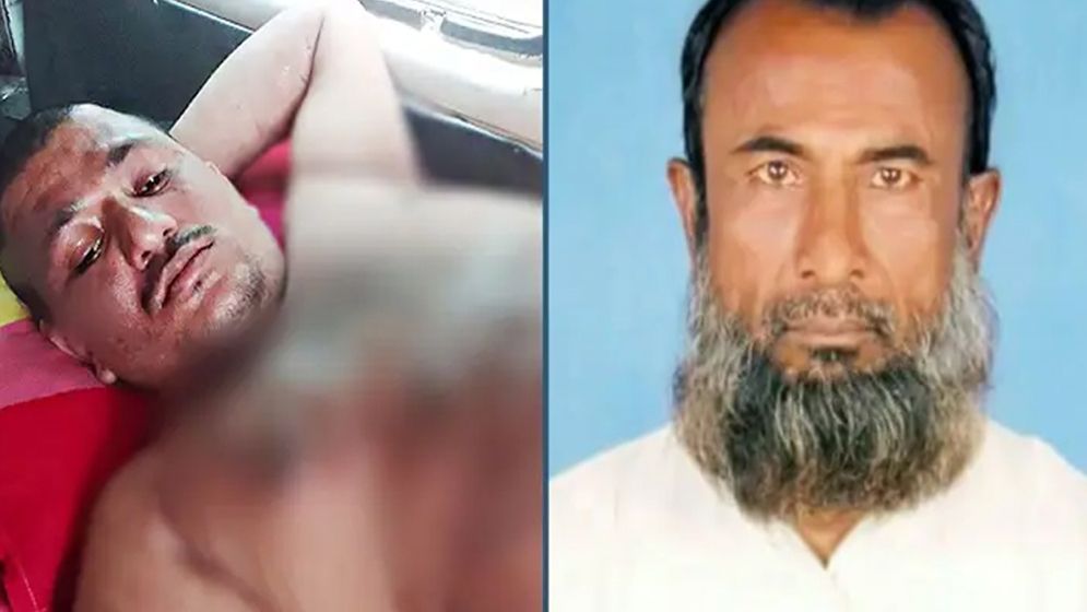 পাঞ্জাবি টেনে ধরায় বুদ্ধিপ্রতিবন্ধীকে গরম পানিতে ঝলসে দেওয়ার অভিযোগ