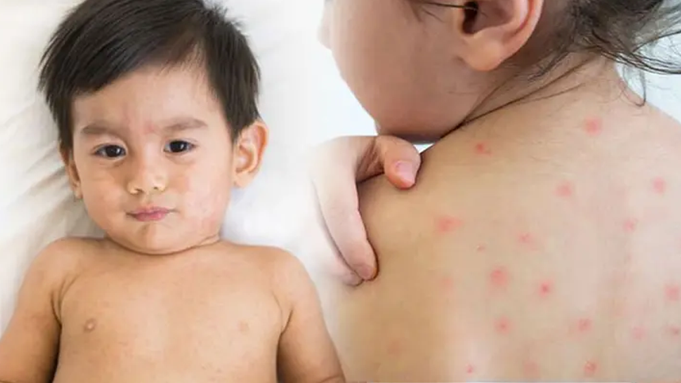 শিশুদের হামের প্রকোপ ও প্রতিকার, অভিভাবকদের যা জানা জরুরি