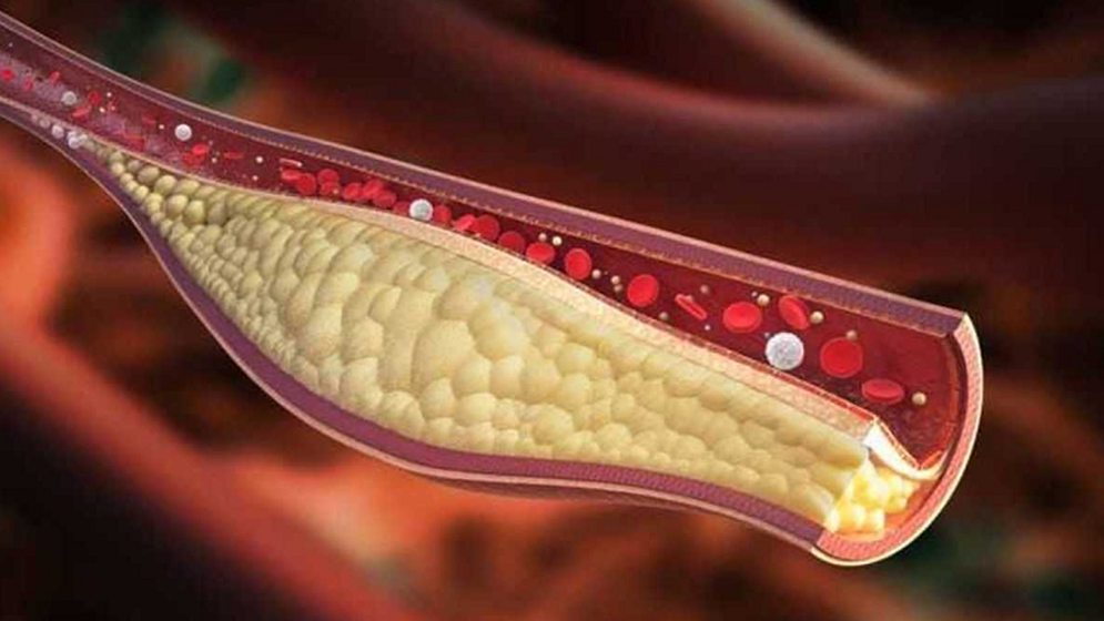 কোলেস্টেরল নিয়ন্ত্রণের ঘরোয়া উপায় জেনে নিন