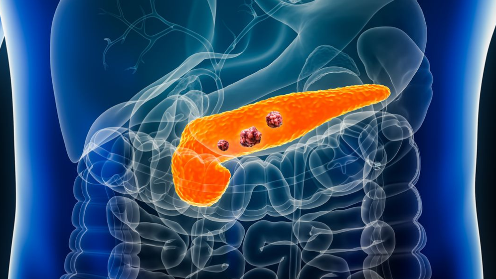 অগ্ন্যাশয় ক্যানসার: মৃত্যুর ঝুঁকি কমাতে পারে যে ওষুধ