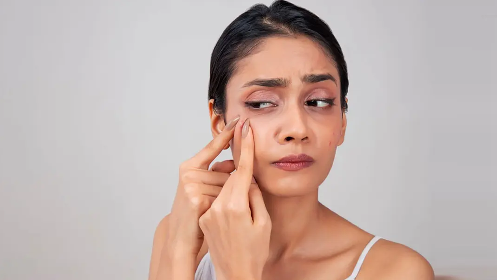 ব্রণ নিয়ে সতর্কতা