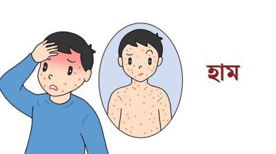 ময়মনসিংহে হামে আরও এক শিশুর মৃত্যু