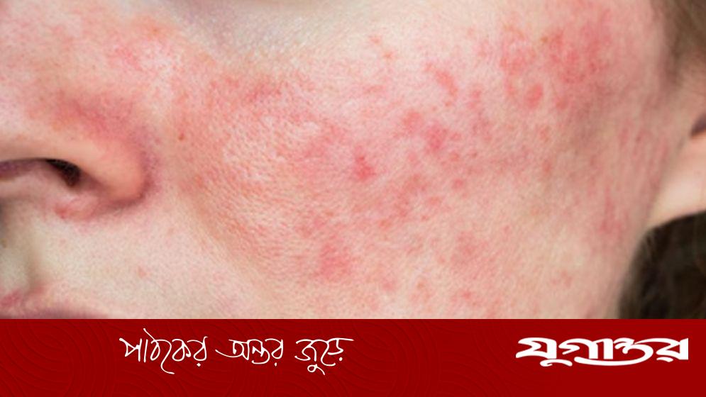 গরমে মুখ ভরে যাচ্ছে লালচে র‌্যাশে, ঘরোয়া উপকরণ ব্যবহারেই সমাধান