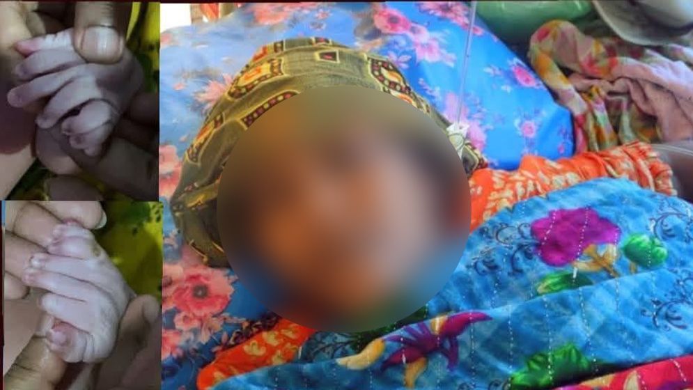 ৩০ আঙুল নিয়ে জন্ম নেওয়া শিশুটি মারা গেছে