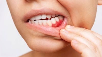 মাড়ি দিয়ে রক্ত পড়া ও মুখের দুর্গন্ধ