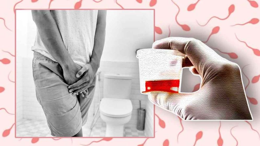 প্রস্রাবের সঙ্গে শ্বেতস্রাব?—কিডনি বিকল হওয়ার লক্ষণ নয় তো?