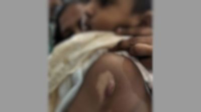অগ্নিদগ্ধ সারামণির চিকিৎসার দায়িত্ব নিলেন কায়সার কামাল