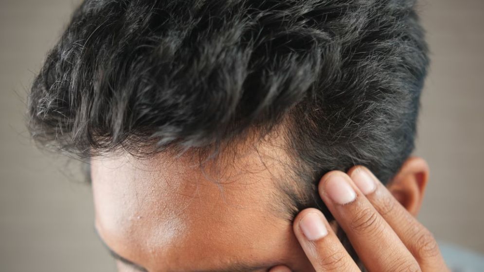 অল্প বয়সে চুল পড়ার কারণ কী? জানালেন বিশেষজ্ঞ