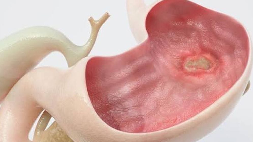 কিভাবে বুঝবেন আপনার আলসার হয়েছে