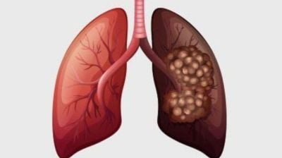 যে ৫ অভ্যাসে বাড়ছে ফুসফুস ক্যানসারের ঝুঁকি