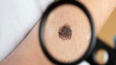 শরীরের আঁচিলগুলোকে সাধারণ ভেবে ভুল করছেন না-তো?
