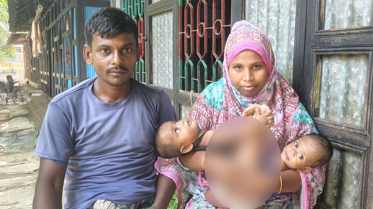 এক দেহে দুই প্রাণ, আলাদা করার স্বপ্ন থমকে আছে দারিদ্র্যে